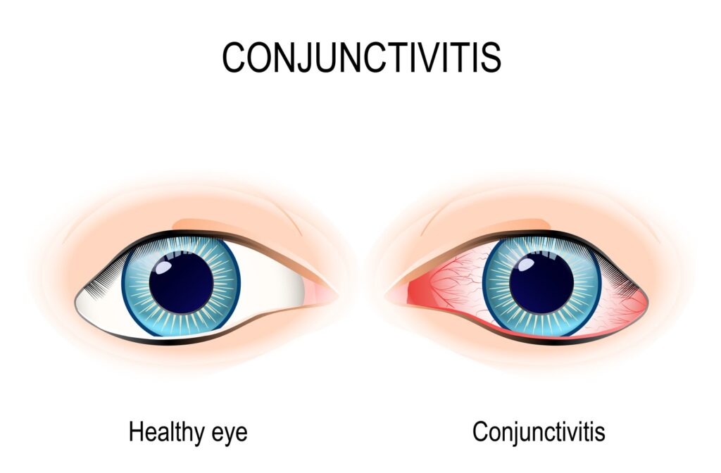 llustration of healthy eyes on the left and conjunctivitis eyes on the right