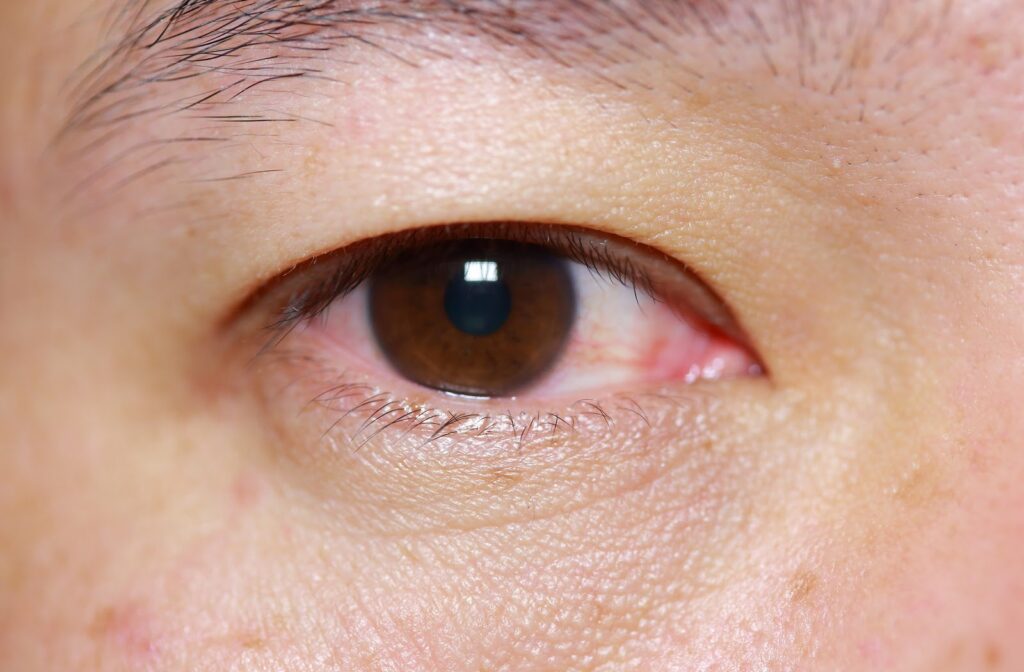 Close up of eye that has pink eye (conjunctivitis) symptoms