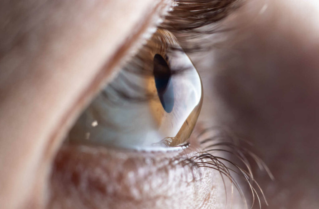 A close-up of an eye with a bulging cornea.