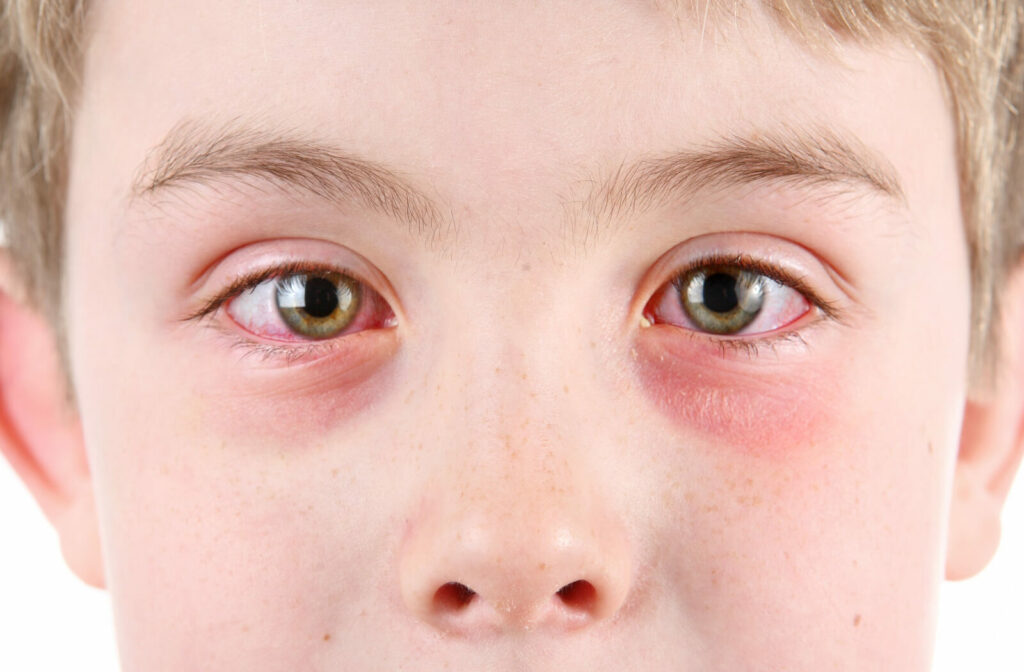 Close-up of a child's red, irritated eyes.