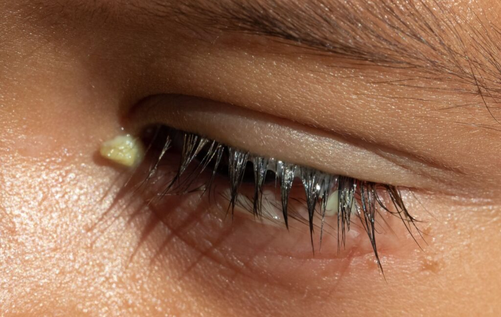 A person looks down. Their eye and eyelashes are coated with a thick, yellowish eye crust after waking up.